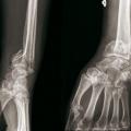 Fracture de Goyrand-Smith gauche