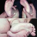 Metatarsus varus chez un nourrisson