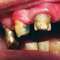 Édentement et gingivite ulcéro-nécrotique 