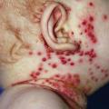 Eczema herpeticum