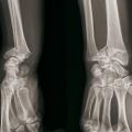 Fracture articulaire en T sagittale droite