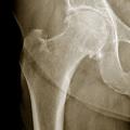 Coxarthrose