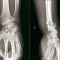 FRACTURES DU RADIUS