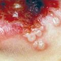 herpes
