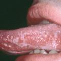 Leucoplasie orale chevelue